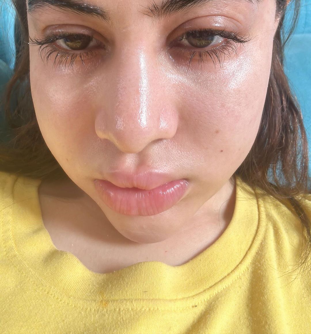 Bigg Boss OTT Fame Uorfi Javed Latest Post Grabbed Attention For Sharing Her Swollen Face. Look Over to Know What Caused Her To This Condition!